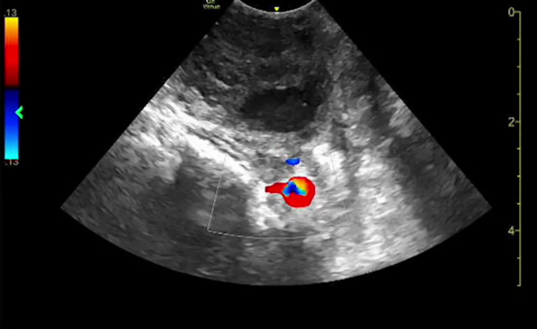 Intraoral Ultrasound Guided Peritonsillar Abscess Drainage