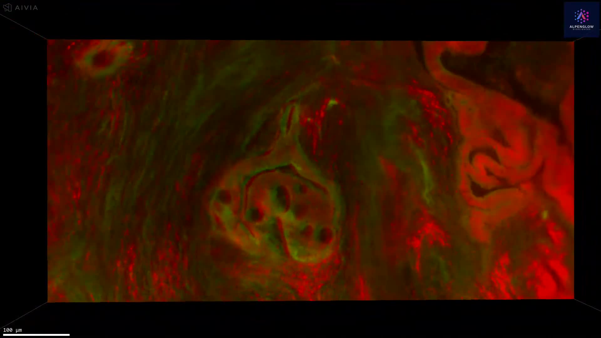 3D fluorescence imaging of colorectal cancer FFPE tissue