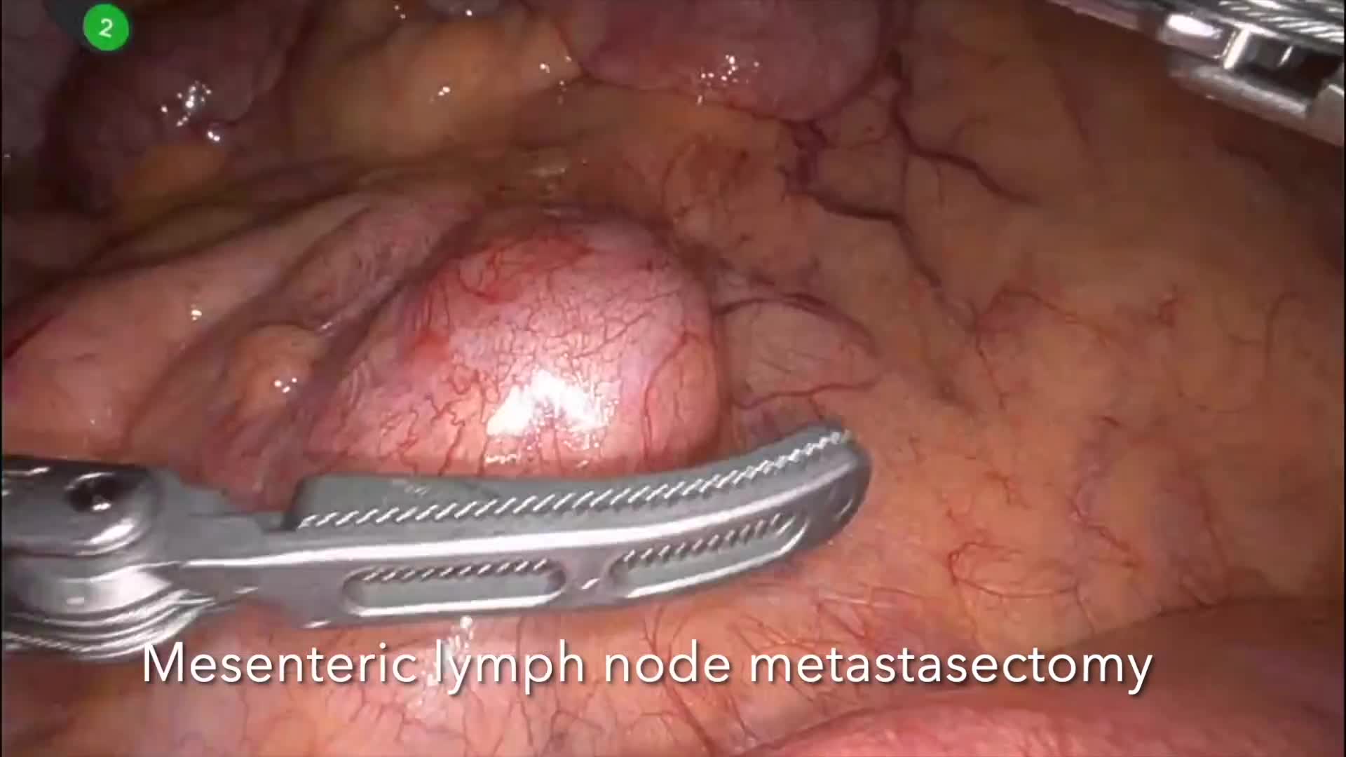 Robotic Ultrasound-Guided Microwave Ablation for Neuroendocrine Tumor Liver Metastases