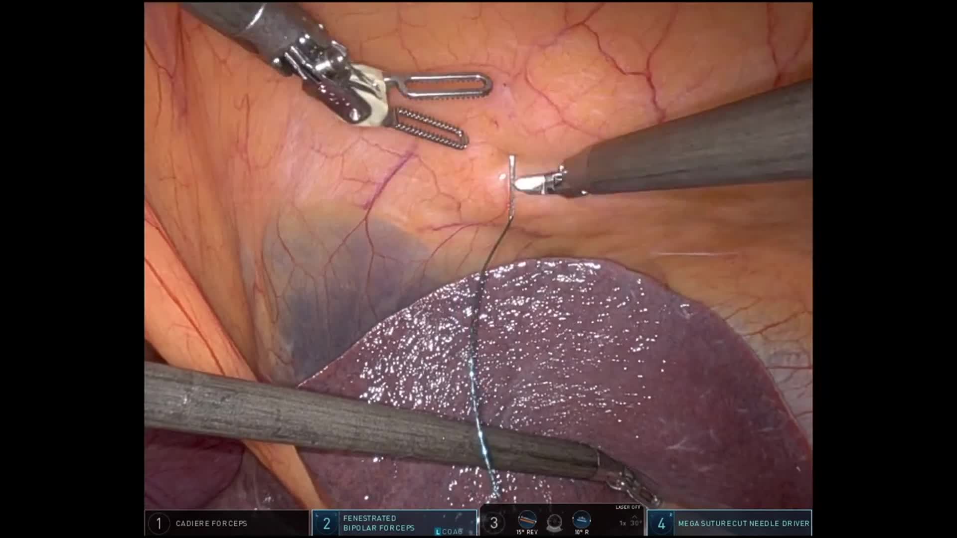 Robotic Celiac Axis Lymphadenectomy for Metastatic Esophageal Squamous Cell Carcinoma