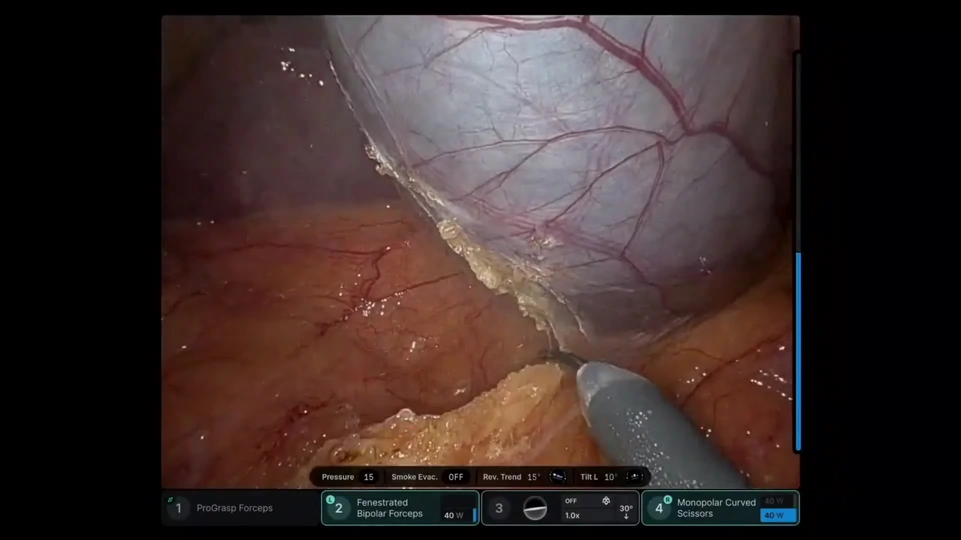Robotic Cholecystectomy for Symptomatic Cholelithiasis