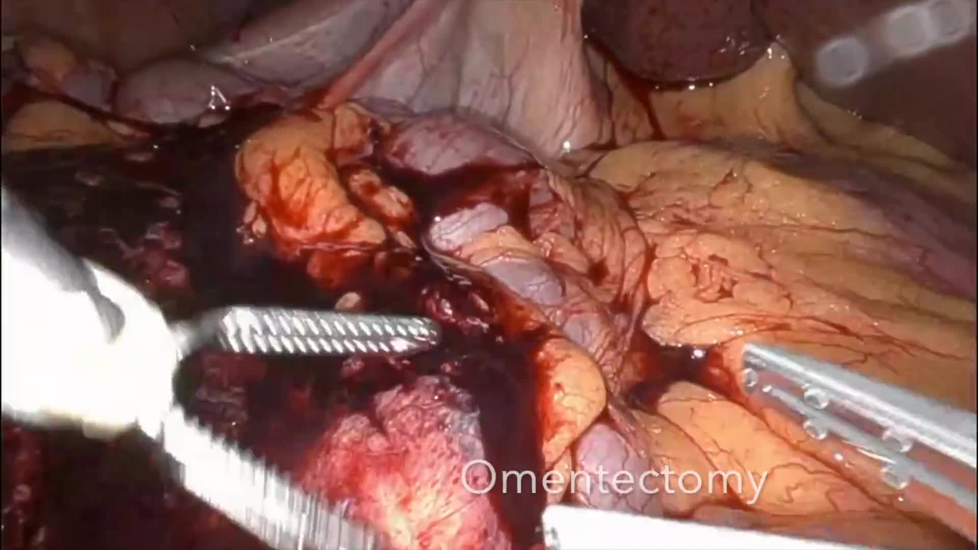 Robotic Staging Laparoscopy, Omentectomy, and Ultrasound-Guided Microwave Ablation for Metastatic CRC