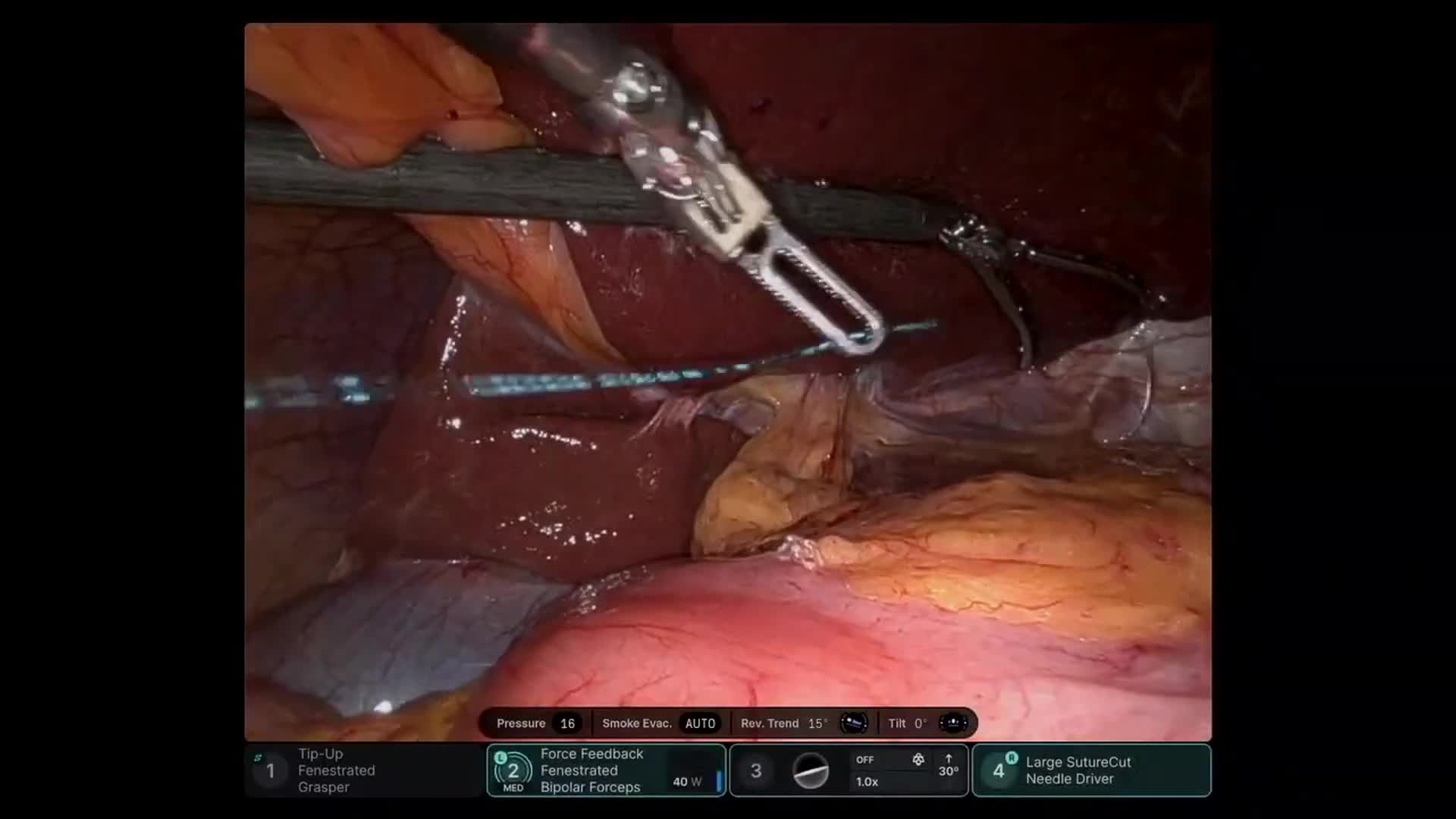 Robotic Subtotal Distal Pancreatectomy for Borderline-Resectable Pancreatic Adenocarcinoma