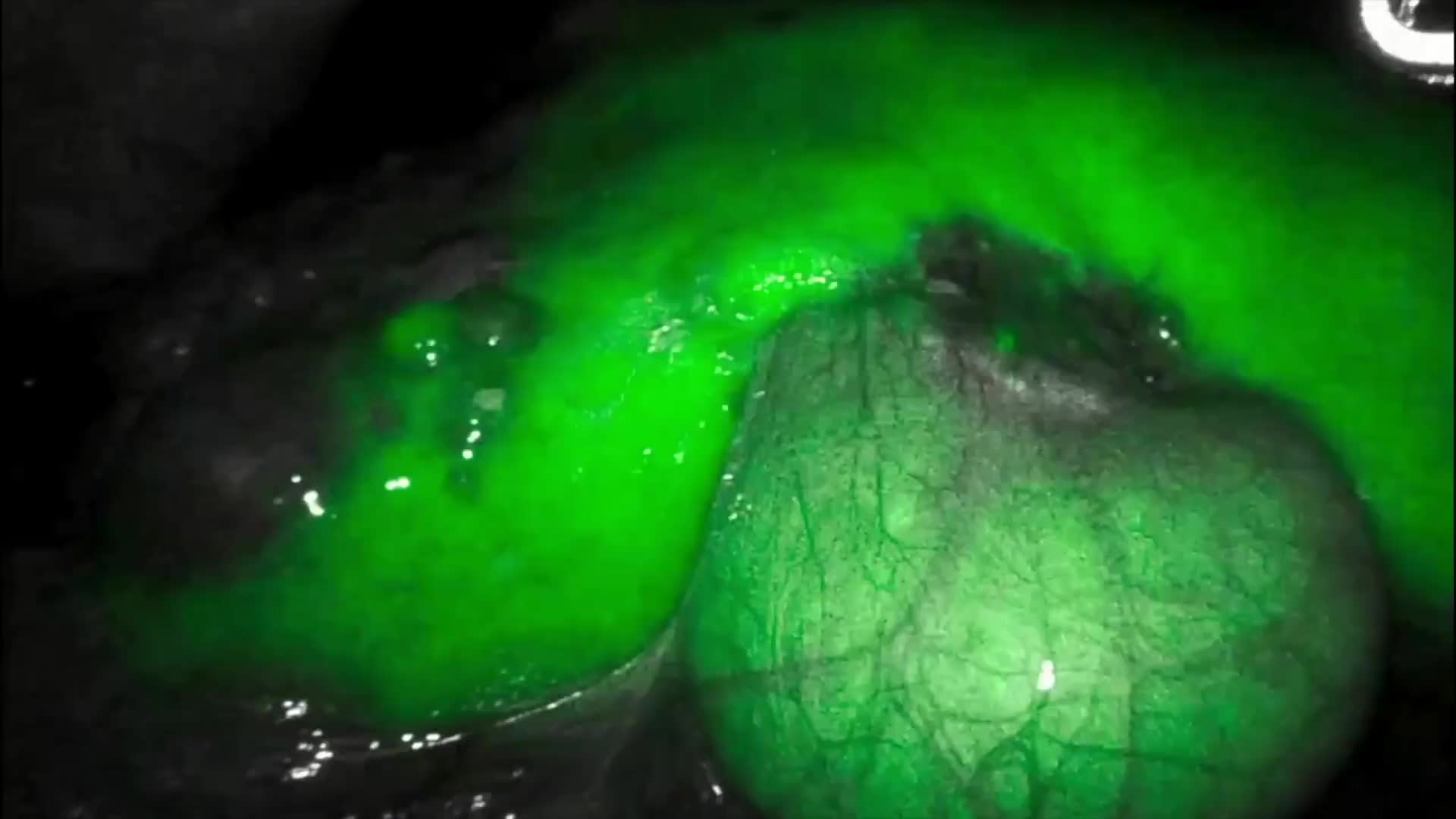 Robotic Hepatic Cyst Fenestration and Partial Hepatectomy for Giant Liver Cysts