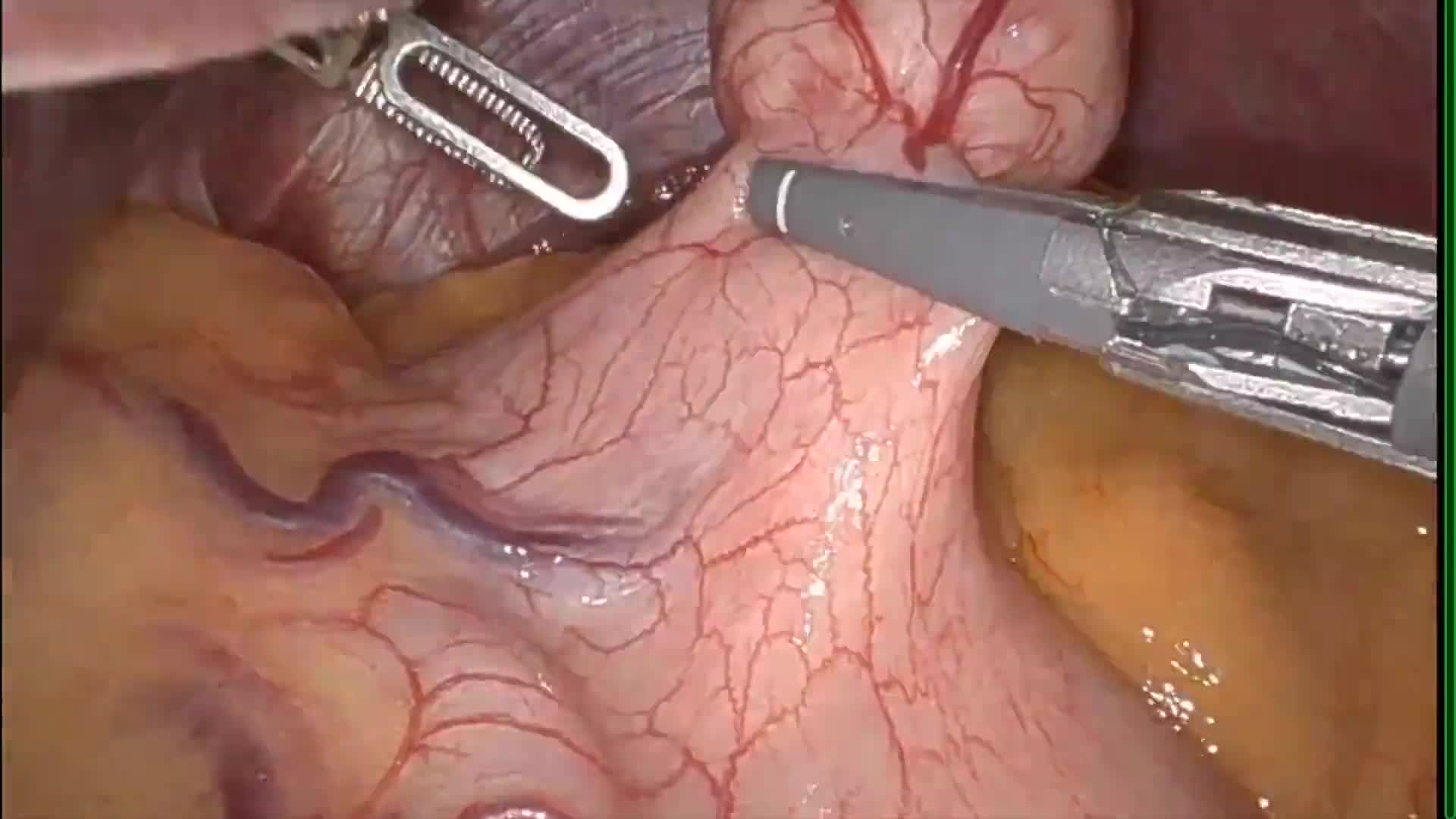 Robotic Partial Gastrectomy for Gastric Gastrointestinal Stromal Tumor (GIST)