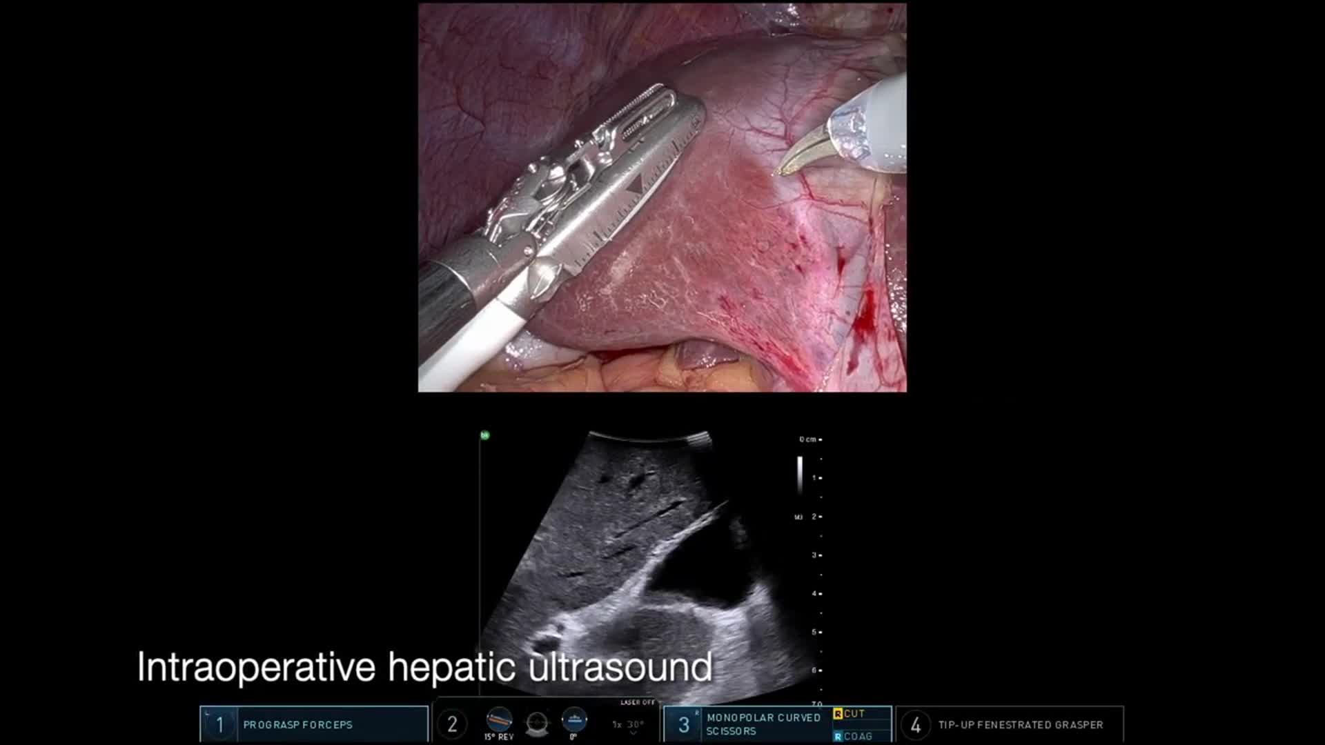Robotic Left Hepatectomy for Metastatic Renal Cell Carcinoma