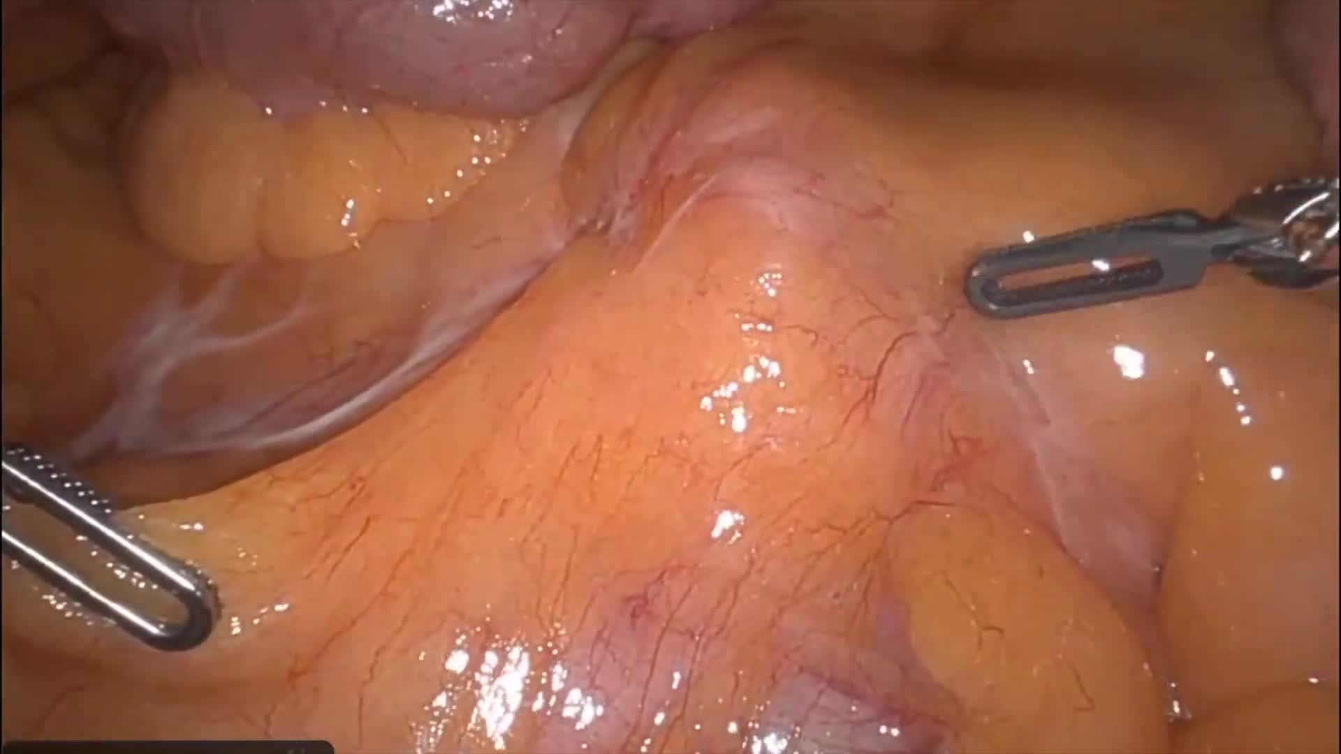 Robotic Small Bowel Resection for Metastatic Ileal Neuroendocrine Tumor