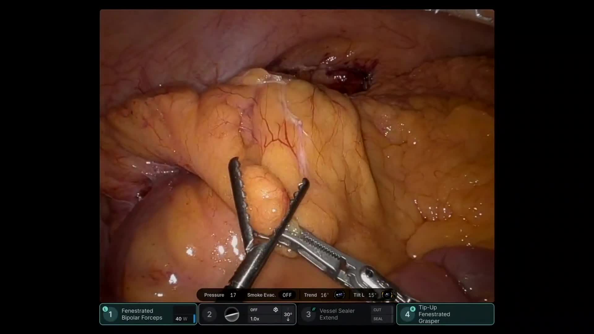 Robotic Right Hemicolectomy for Cecal Adenocarcinoma with Intracorporeal Anastomosis