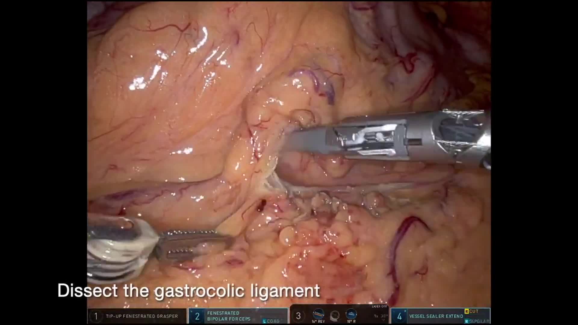 Robotic Ivor Lewis Esophagectomy for Small Cell Neuroendocrine Carcinoma of the Distal Esophagus
