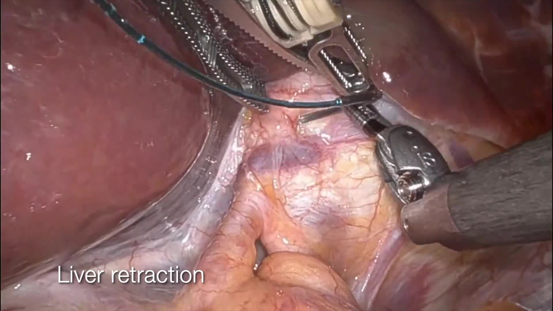Robotic Distal Pancreatectomy and Splenectomy for Pancreatic Neuroendocrine Tumor