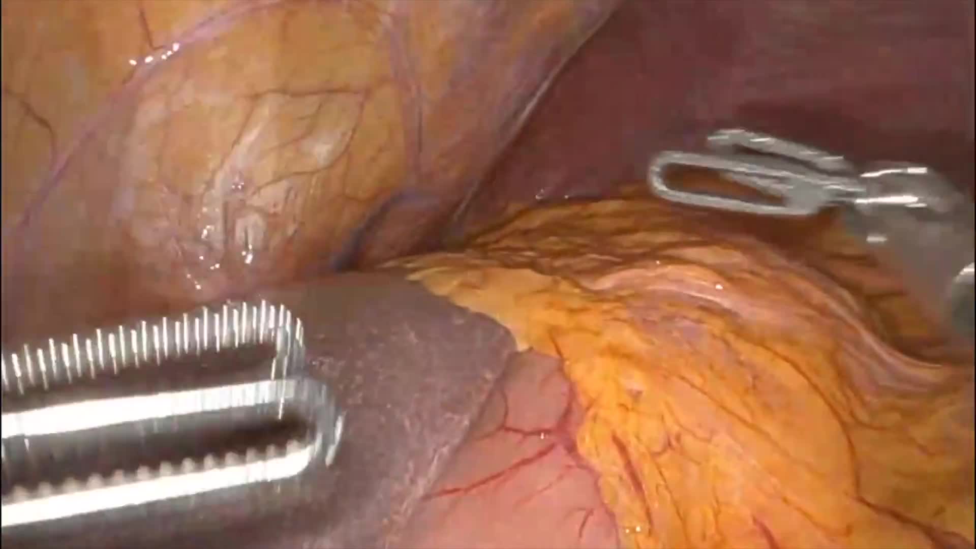 Robotic Feeding Jejunostomy for Metastatic Gastroesophageal Junction Adenocarcinoma with Dysphagia