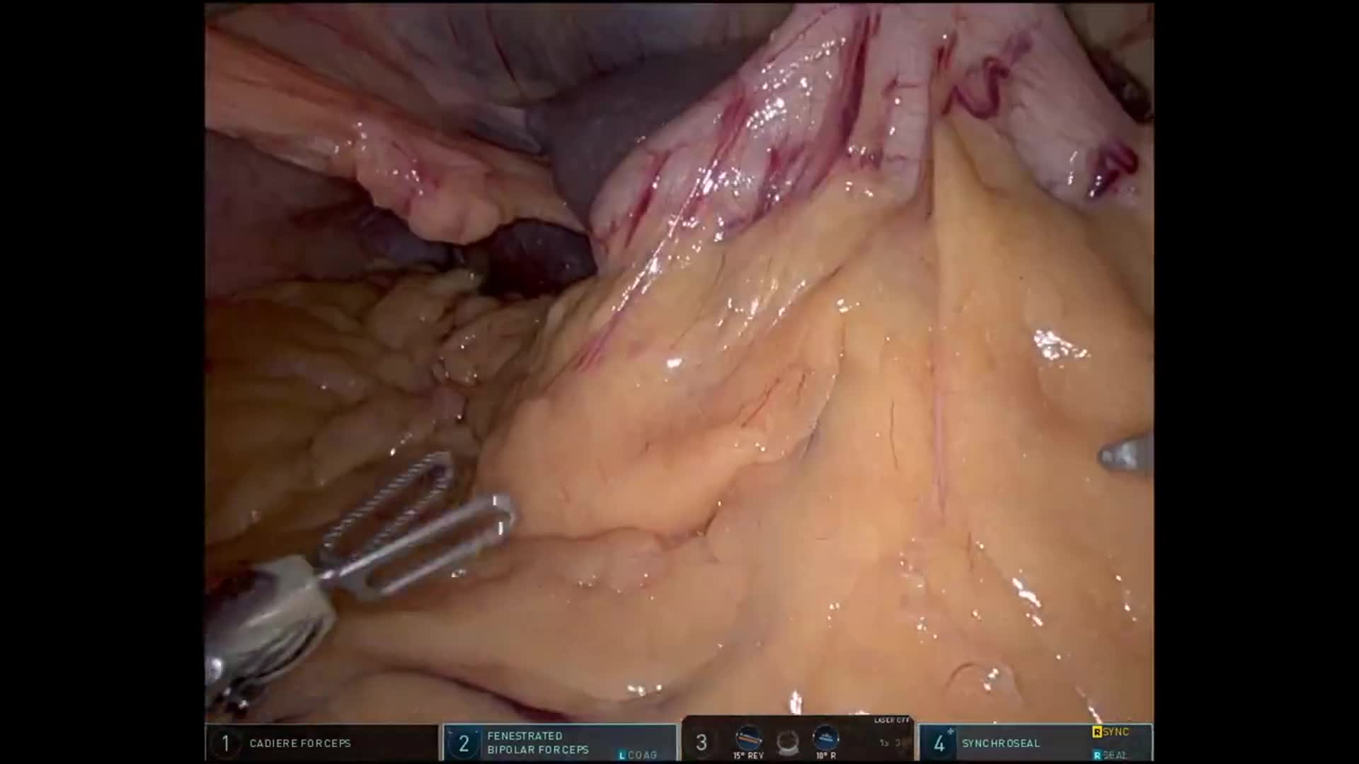 Robotic Subtotal Distal Pancreatectomy for Resectable Pancreatic Body Carcinoma in a High-Risk Patient