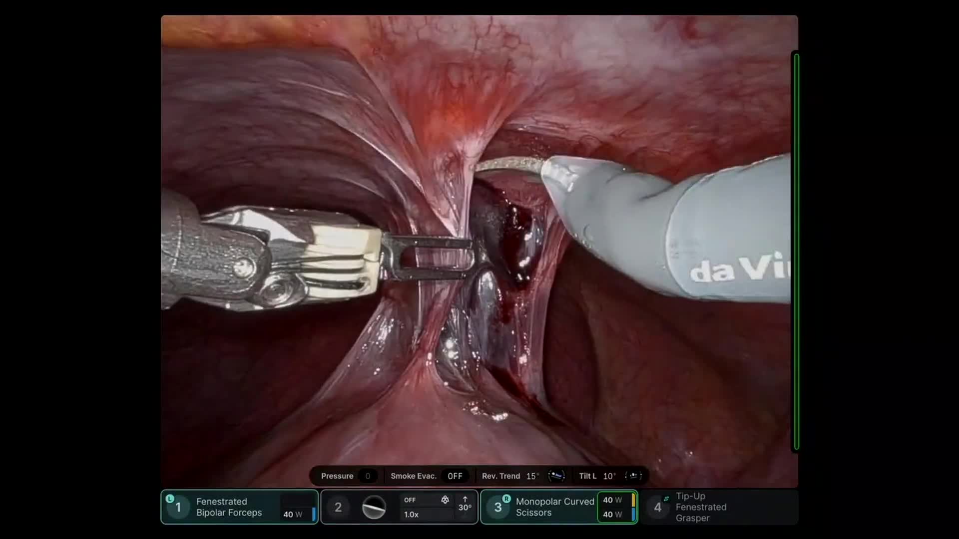 Robotic Right Hepatectomy and Microwave Ablation for Colorectal Liver Metastases