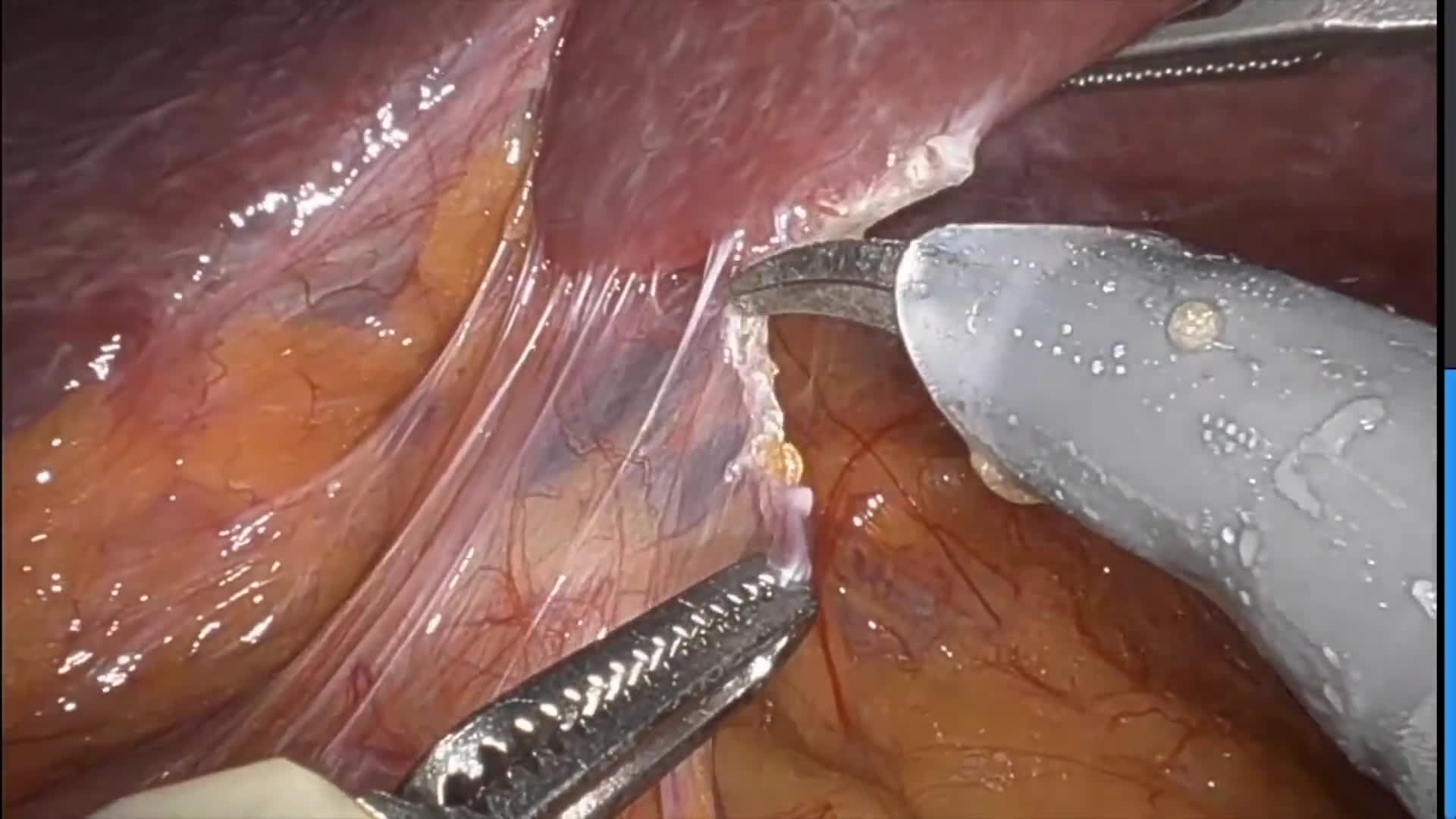 Robotic Cystic Duct Remnant Resection and Common Bile Duct Exploration for Post-Cholecystectomy Syndrome