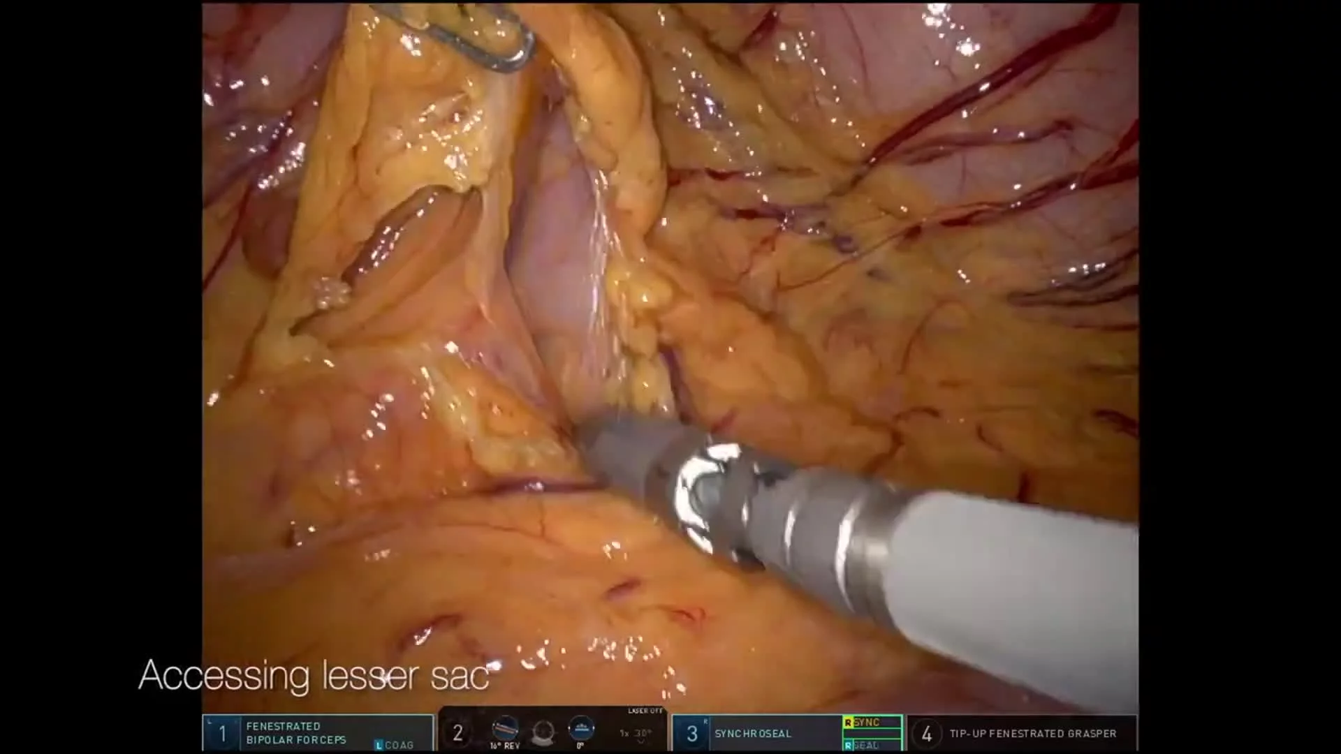 Robotic Pancreaticoduodenectomy (Whipple Procedure) for Duodenal Neuroendocrine Tumor