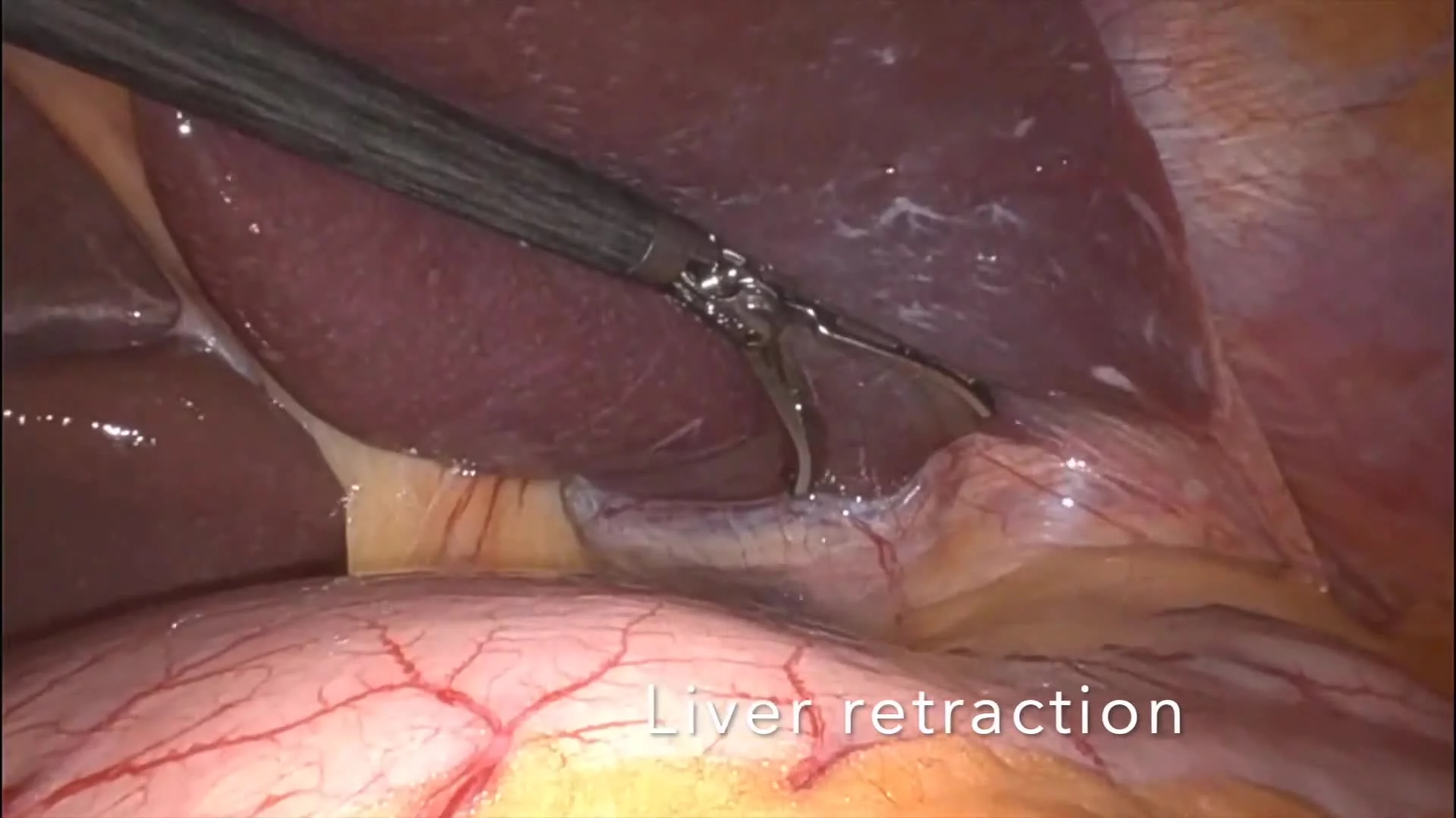 Robotic Enucleation of Pancreatic Neuroendocrine Tumor with Lymphadenectomy After Ileal NET Resection
