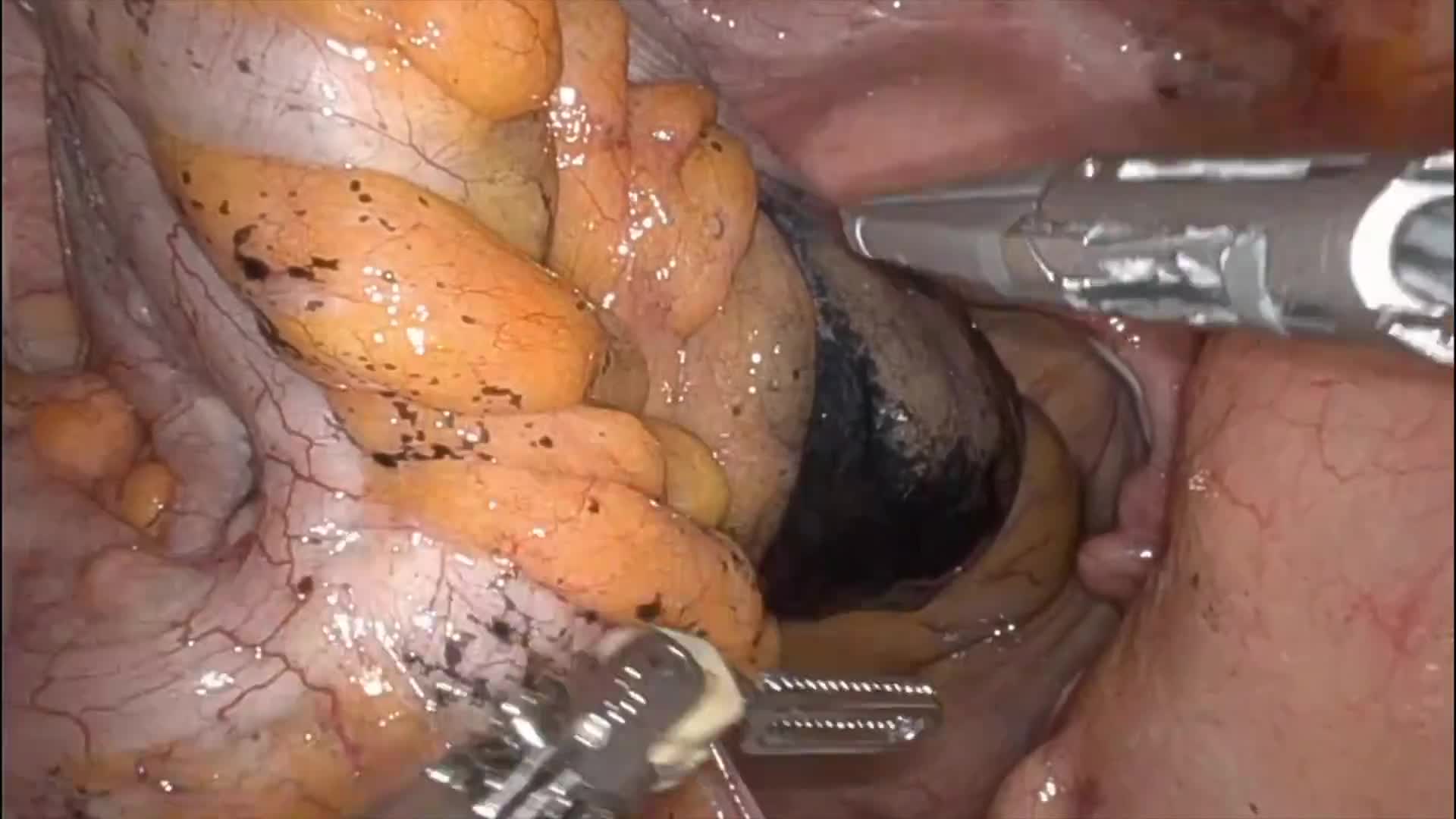 Robotic Low Anterior Resection for Rectosigmoid Colon Cancer
