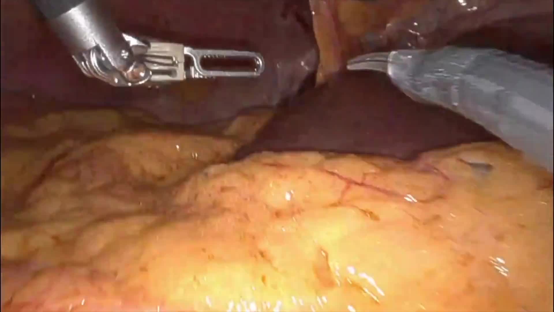 Robotic Splenectomy for Diffuse Large B-Cell Lymphoma of the Spleen